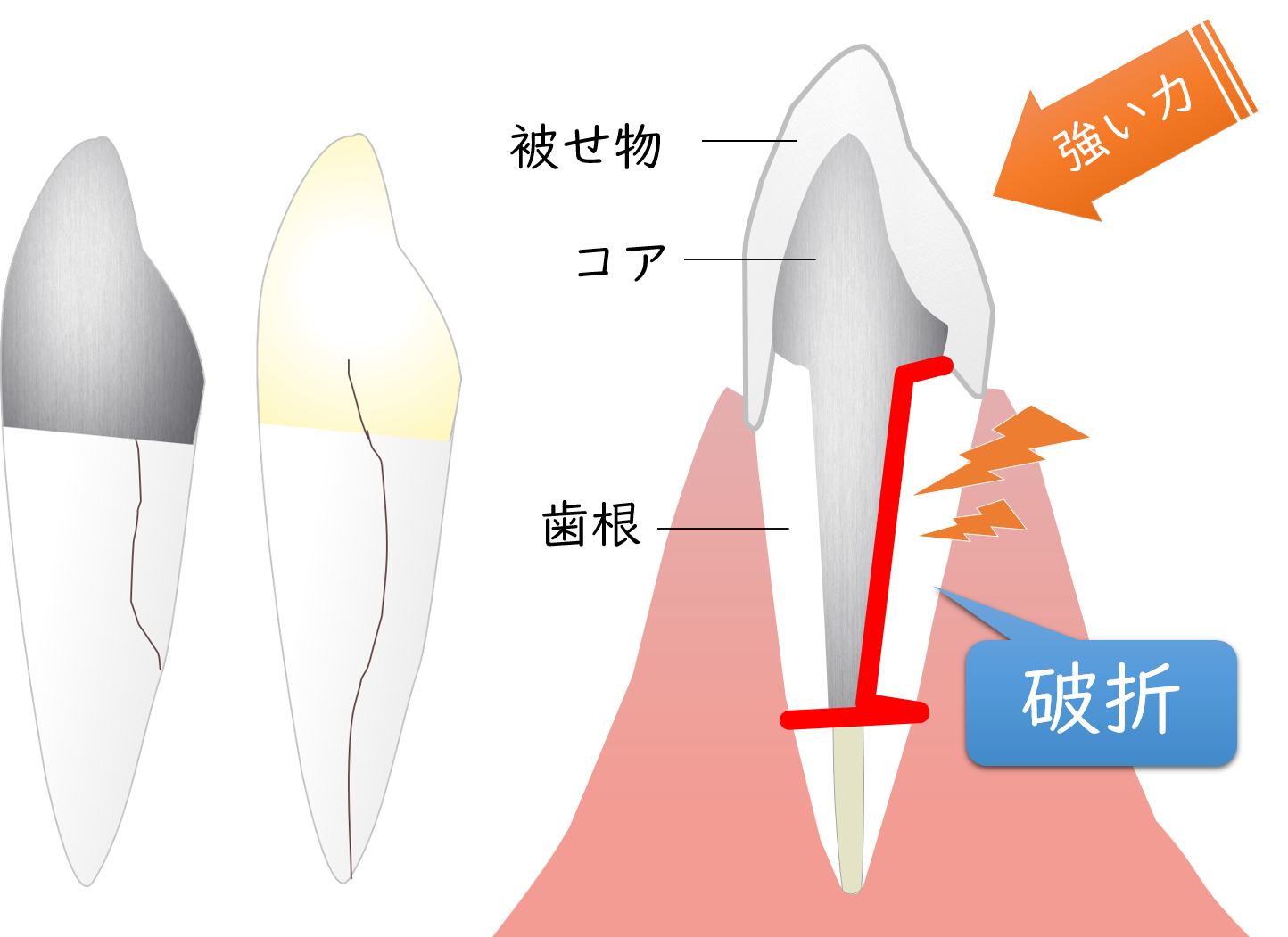 鬼無・飯田町（高松市）の歯医者、キナシおとなこども歯科で歯根破折の治療